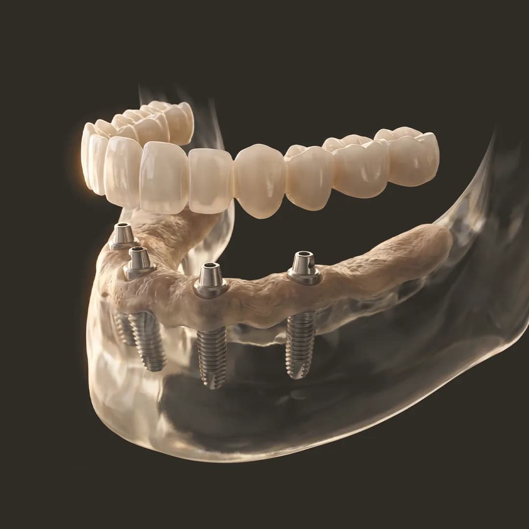 All-on-4 Dental Implants