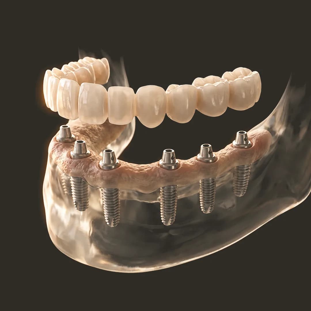 All-on-6 Dental Implants