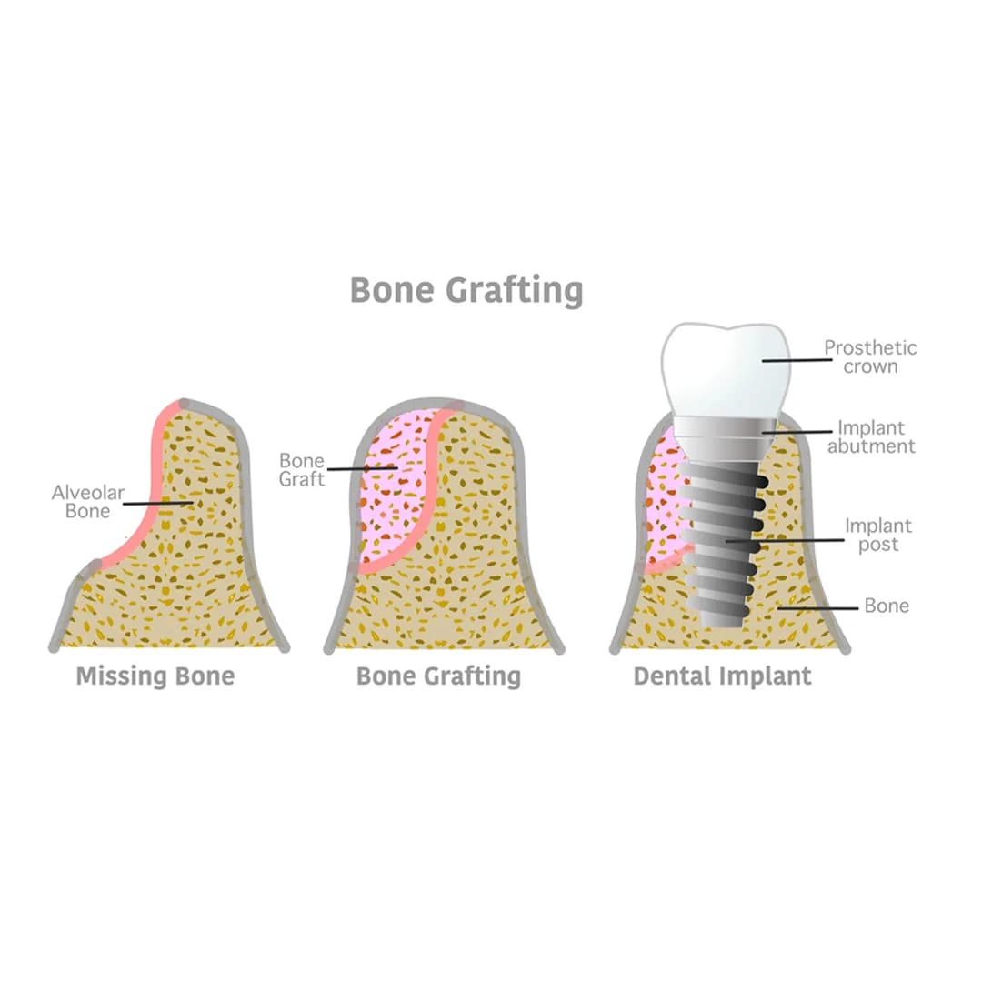 Bone Grafting