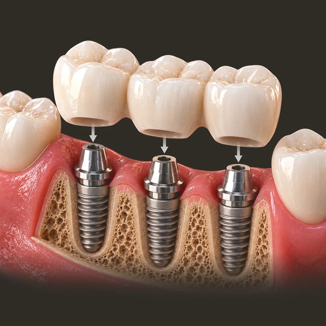 Implants for Multiple Teeth