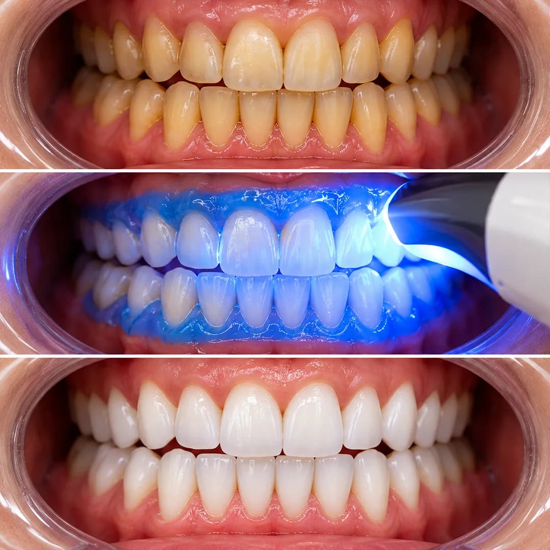 Teeth Whitening